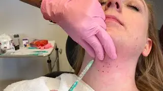 Injectable Fillers 101: Botox, Kybella and Juvederm