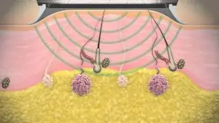 MiraDry&reg; Technology Procedure - Dr. George P. Chatson