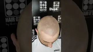 Adio Chelie Micropigmentare Scalp