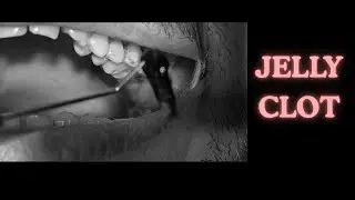 JELLY CLOT on Gingiva, Patient taking Anticoagulants