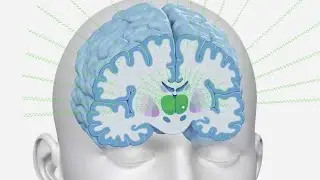 Parkinson&rsquo;s, Tremor & Dystonia: How MRgFUS Ultrasound Treatment Works. Animation. Insightec Exablate