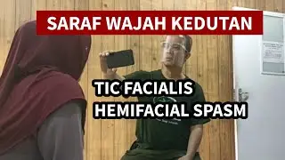 SARAF WAJAH KEDUTAN HEMIFACIAL SPASM TIC FACIALIS 10 TH. 