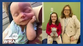 Обнаружение родимых пятен может предотвратить судороги у детей