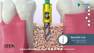 ZENEX PLUS Implant System 