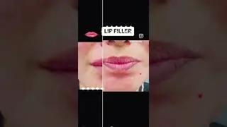 Lip filler to add volume. #lipfillers #lipfillerinjections #lipfillerbeforeandafter #juvedermlips