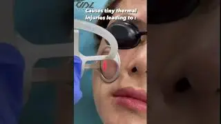 rf microneedling vs co2 laser