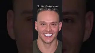 Before and After Porcelain Veneers by: cosmetic dentist Dr. Tejas Patel