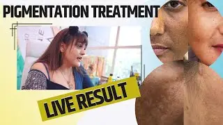 Pigmentation Treatment Live Result || Skin Care Advice || Nisha Lambha ||