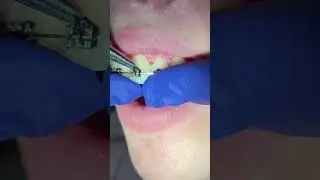 Orthodontic wires- NiTi and Stainless Steel wires - Tooth Time Family Dentistry New Braunfels