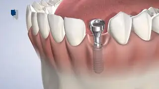 Dental Implants at Northern Nevada Oral & Maxillofacial Surgery, Reno and Sparks, NV