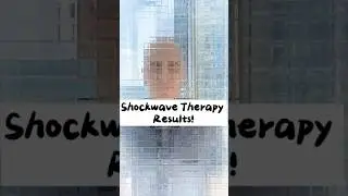 SHOCKWAVE RESULTS | CHRONIC PELVIC PAIN SYNDROME #cpps #malepelvicpain #prostatitis