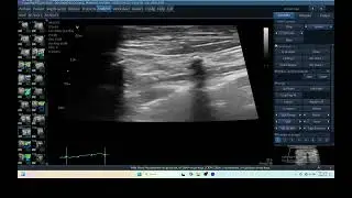 IQ 215 PULMONARY EFFUSION LUNG ULTRASOUND ECHOPAC ANALYSIS HEART WORM DISEASE HARD