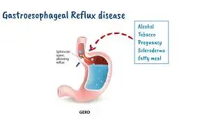 Understanding Gastroesophageal Reflux Disease (GERD )