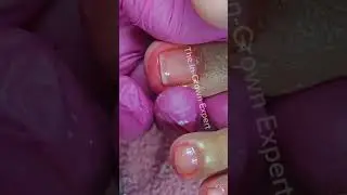 Full video pedicure with ingrown removal 