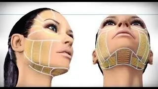 Ameliyatsız İple Y&uuml;z Askılama | Dr.Aslı ŞİMŞEK