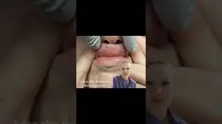 Dissolving migrated lip filler