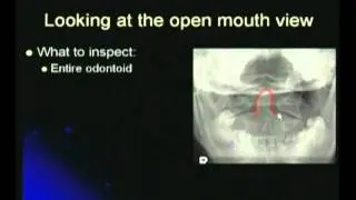 Cervical Spine Mouth View