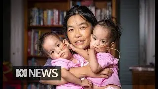 Conjoined twins Nima and Dawa declared ready for separation surgery on Friday  | ABC News