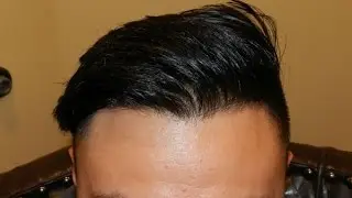 Lower Hairline Surgery Results on Asian Male by Dr. Diep  