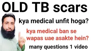 Old TB scars for uae medical update | info online