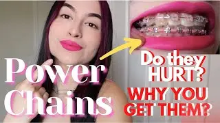 Braces: Power Chains // What are they? Do they HURT?(Everything you need to know)