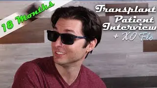 Hair Transplant Results  -  12 Month Patient Follow-Up Interview with Maverick