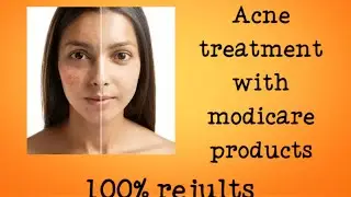 Acne treatment with modicare products ( सिर्फ २ हफ्तों में मुंहासों से निजात पाएं )