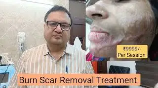 Burn Scar Removal Treatment  | 6 Step Treatment Protocol.