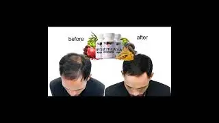 RESTOLIN HAIR GROWTH REVIEWS, DOES IT WORK?