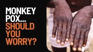Monkey Pox 2024:  Should you be worried...