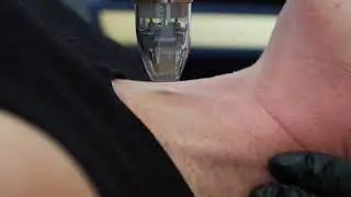Sylfirm X Radio Frequency Microneedling with Daria (No Dialogue)