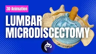 Поясничная микродискэктомия &mdash; 3D-анимация