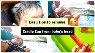 HOW TO REMOVE CRADLE CAP FROM BABY HEAD👶🏻 || VERY SIMPLE TRICK✨️