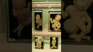 Real human bodies.Manipal museum of Anatomy & Pathalogy#Manipal#truth#believe#india#mindblowingfacts