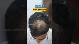 Hair loss Treatment Result | GFC Therapy | GFC Therapy in Delhi | #chandrahairclinic