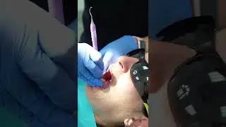 IPR treatment with Bitesoft Pro! #clearaligners #dentist #dentalcare