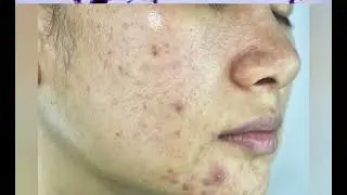P acnes - Bacteria behind acne