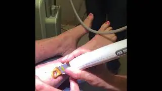 Spider Vein Treatment with the Cutera XLV Laser