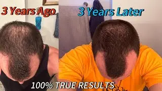 Hims Hair Loss: The Brutal Truth After 3 Years (Before & After)