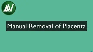 Manual Removal of Placenta
