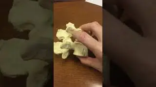 Ortho (Spine): Vertebral foramen and notch