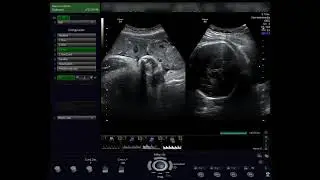 Doppler obstétrico en 3 pasos