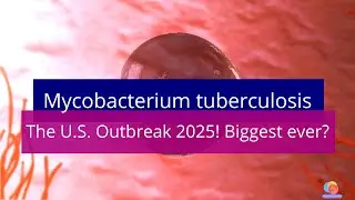 Largest Tuberculosis Outbreak in U.S. History &ndash; What You Need to Know & How to Stay Safe