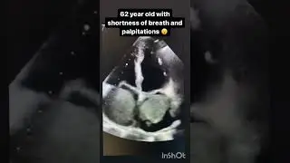 Bi-atrial Myxoma- A Super Rare Case