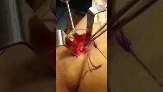 Sentinel node biopsy for breast cancer