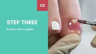 KeryFlex Nail Restoration | Podiatrist Sydney