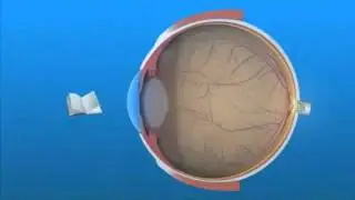 Presbyopia Explained - Maryland Ophthalmologist - Dr. Anthony O. Roberts