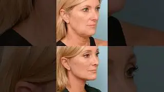 I Had a Facelift After Breast Cancer, This Is My Comeback #Facelift