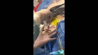 Extracorporeal CPR ECPR cannulation at IFAD2018