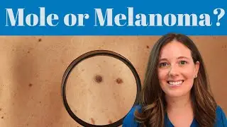 Do You Have a Mole or Melanoma? | Dermatology Insights